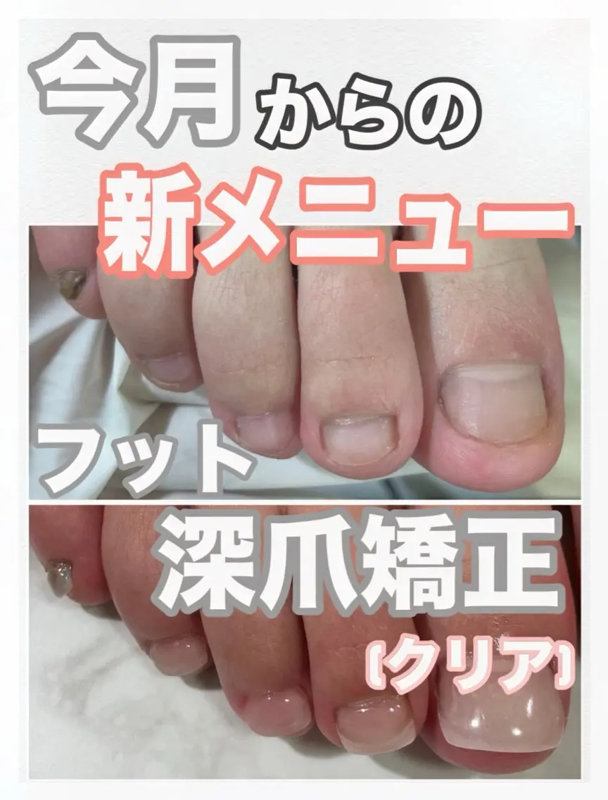 フット深爪矯正【長さ出し】◆クリア◆(オフ込/フットバス付) むしったり 割れたり 小さくなった爪も綺麗な状態に✧︎の写真