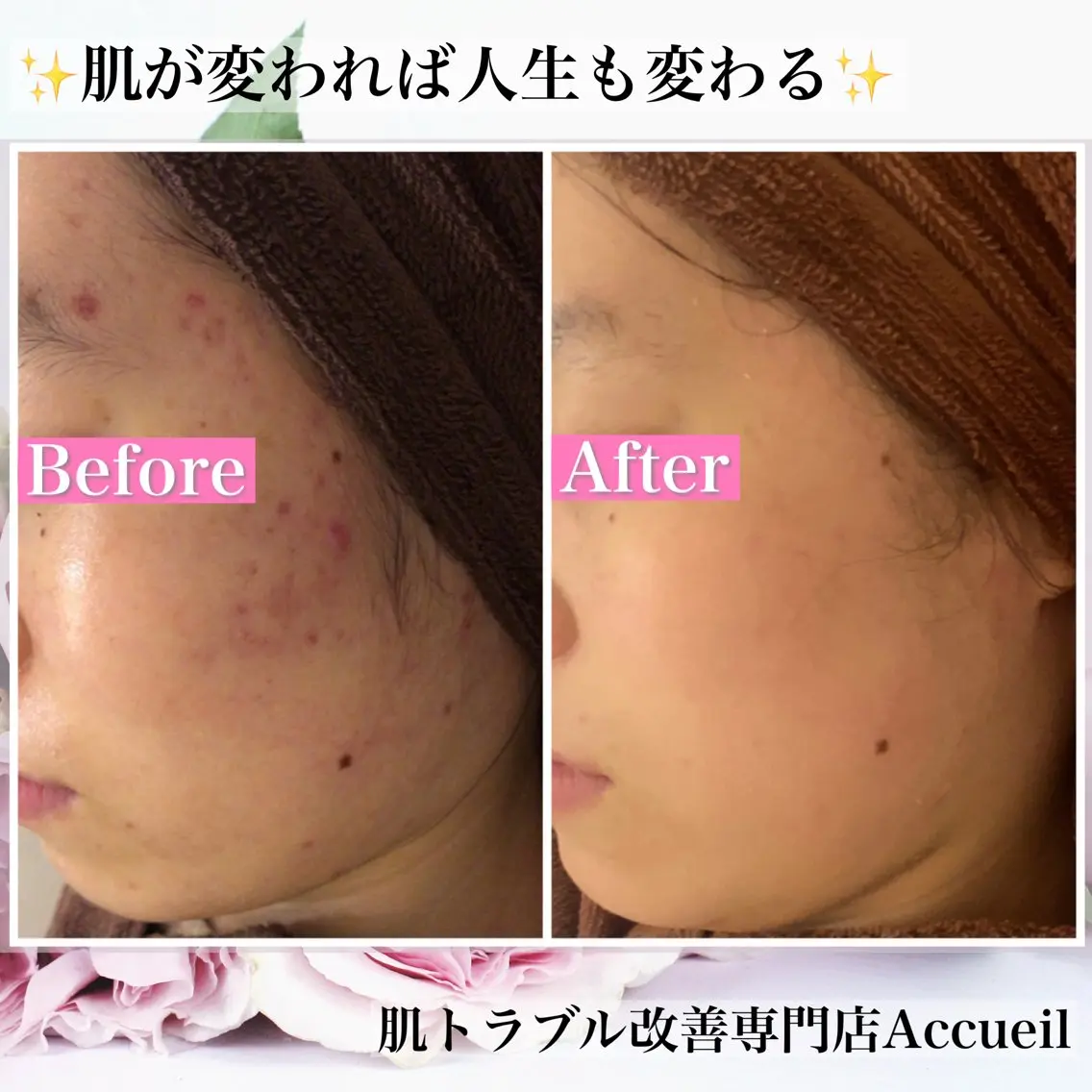 エステ リラク ニキビ・肌質改善専門 ♡人生が変わるサロンのエステ・リラクイメージ