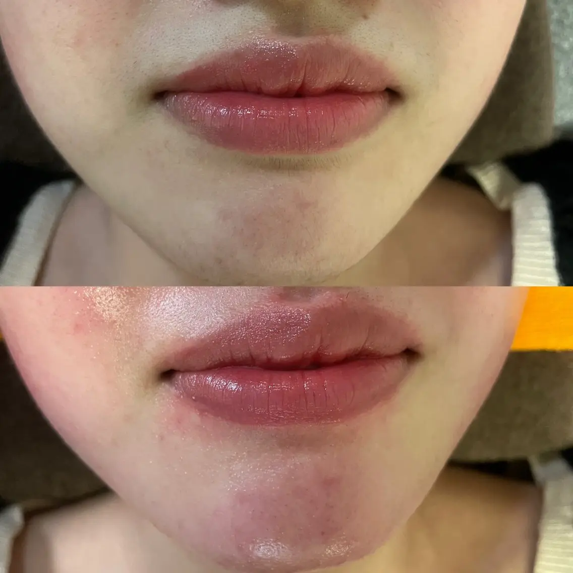 【お肌ツルツル】 フェイシャルWAX脱毛‼︎美容液込☆の写真