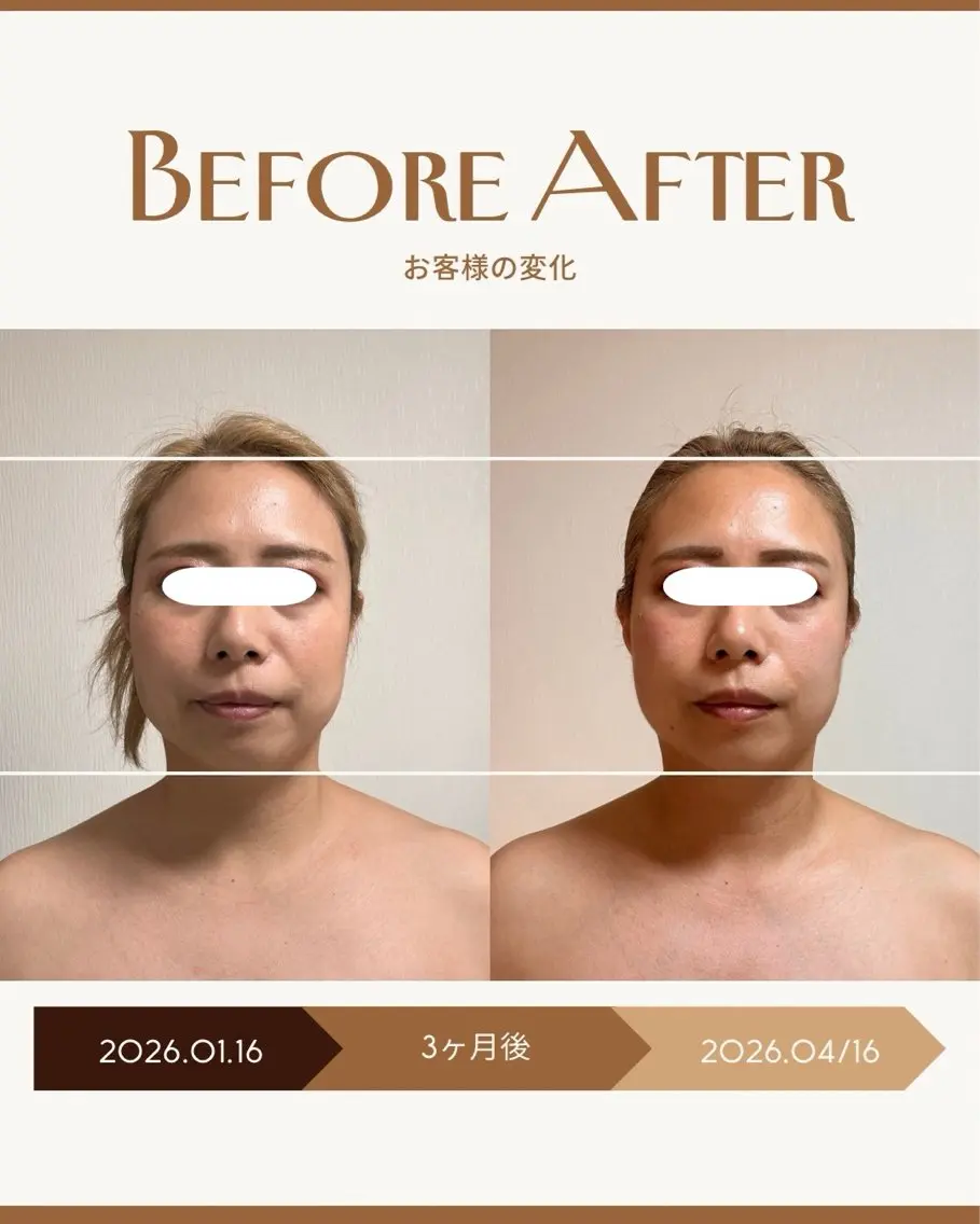 🌿 3ヶ月間(6回来店条件)90分【エラ張り/食いしばり解消小顔ヘッドスパ】の写真