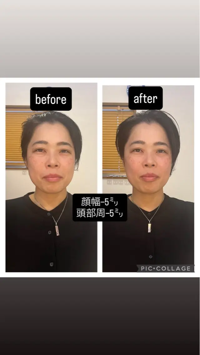 【生涯一度】の小顔矯正【全顔】¥56000⇒¥38000 メンテナンス永久無料付!の写真