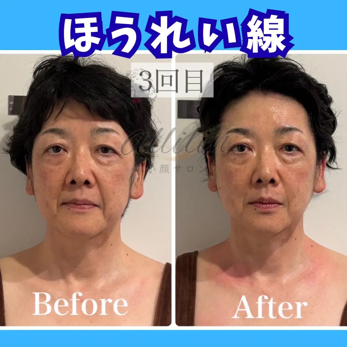エステ 💎小顔ｻﾛﾝ アリリン銀座💎のエステ・リラクイメージ