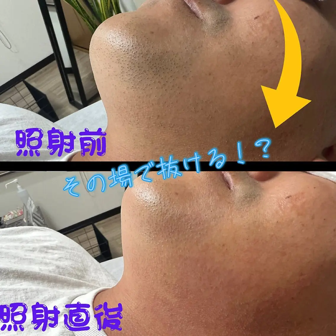メンズ キッズ 脱毛 メンズ脱毛フェリッセ /男女🆗キッズ🆗のエステ・リラクイメージ
