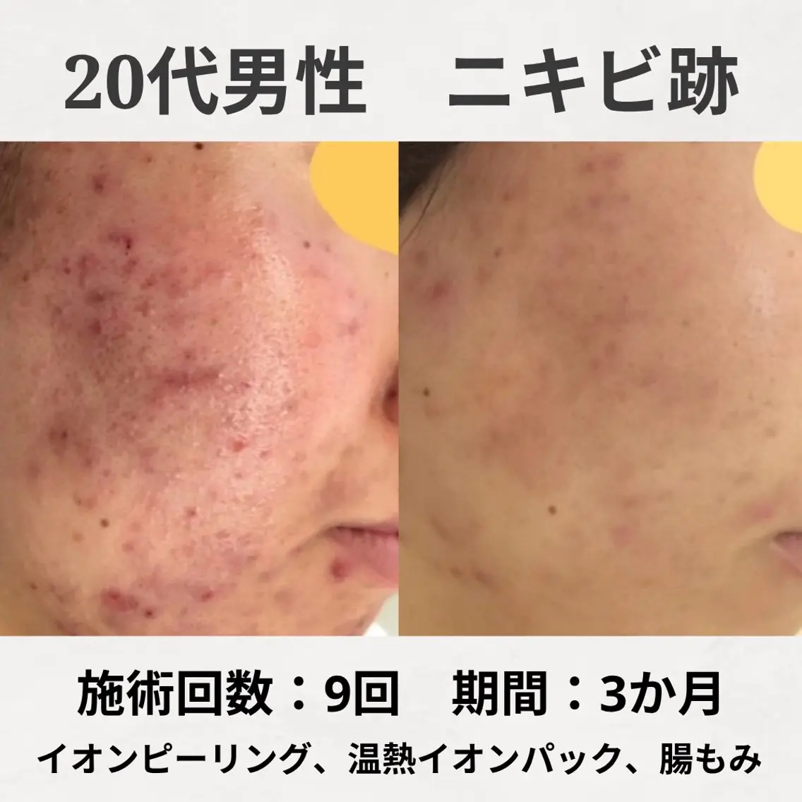 エステ リラク 繰り返すニキビ跡専門 根本改善のエステ・リラクイメージ