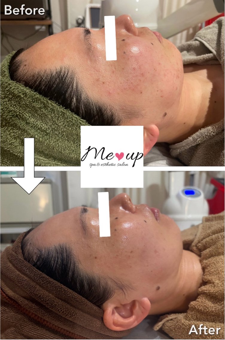 エステ Meup ニキビケア 毛穴・背中ニキビ専門のエステ・リラクイメージ