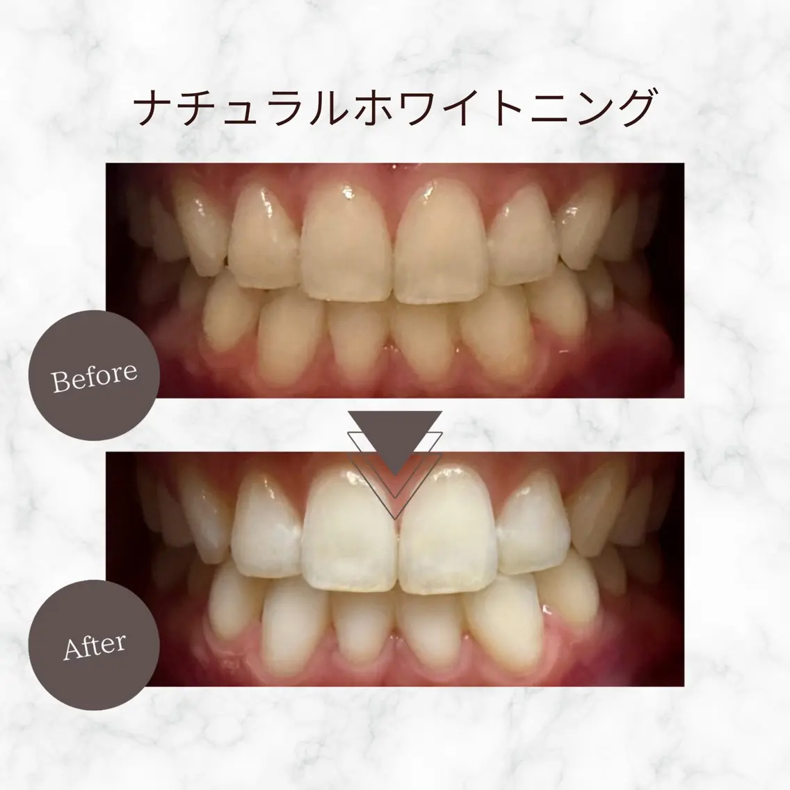 【OPEN記念★10月限定】ナチュラルホワイトニング¥ 3,890→¥1,000!の写真