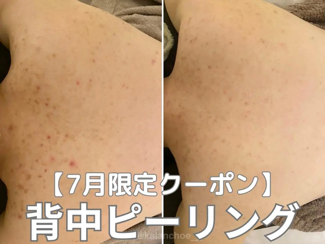 ☆7月限定☆背中ニキビケアピーリング+鎮静水分マスク 21300→15000の写真