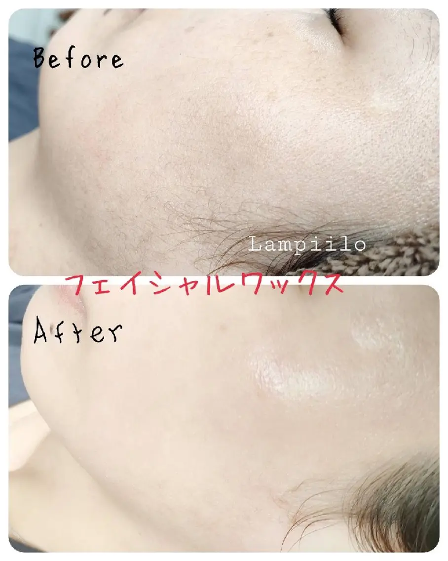 フェイシャルワックス(顔全体・パック付き)の写真