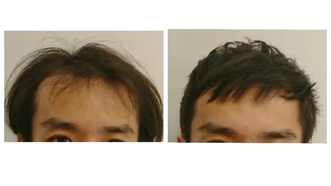 男性限定、薄毛ケアのショートカットモデルの写真