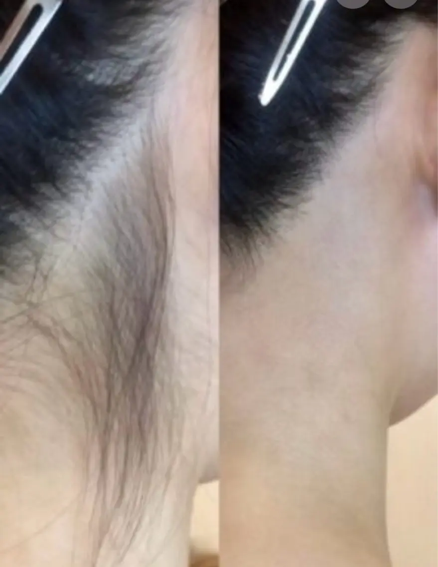 【WAX脱毛】うなじの写真
