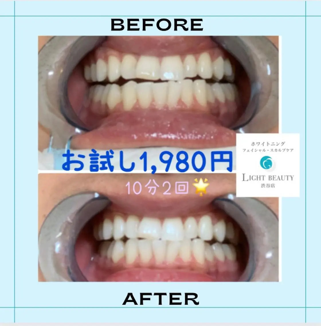 初めての方必見✨1回で効果抜群🌈🦷やって良かったの声多数✨ホワイトニングが今だけ1,980円❣️10分✖️2照射🌟の写真
