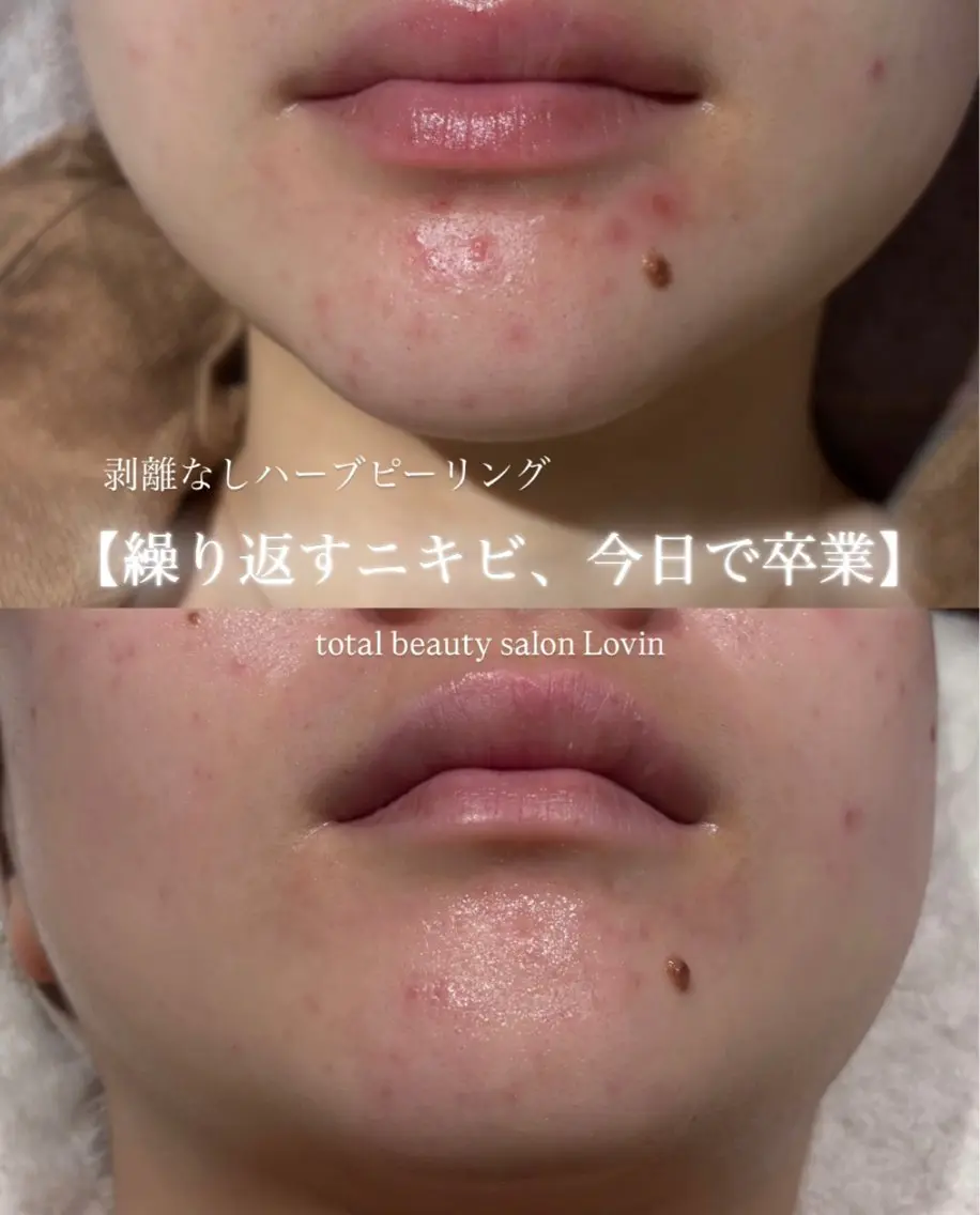 ✨特別クーポン✨【水光肌】ハーブピーリング🌿(剥離無し)の写真