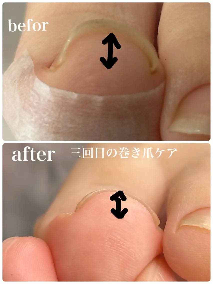 ヘイスッチによる巻き爪ケアの写真