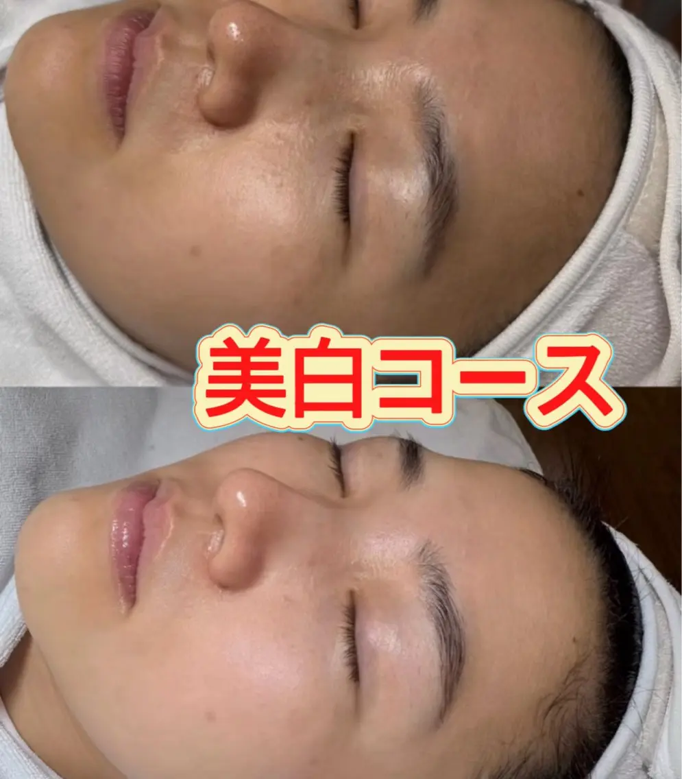 おすすめ✨［FACE］透明感肌へ🦋美白＆保湿＆ピーリング＆小顔マッサージ60分 ¥3980の写真