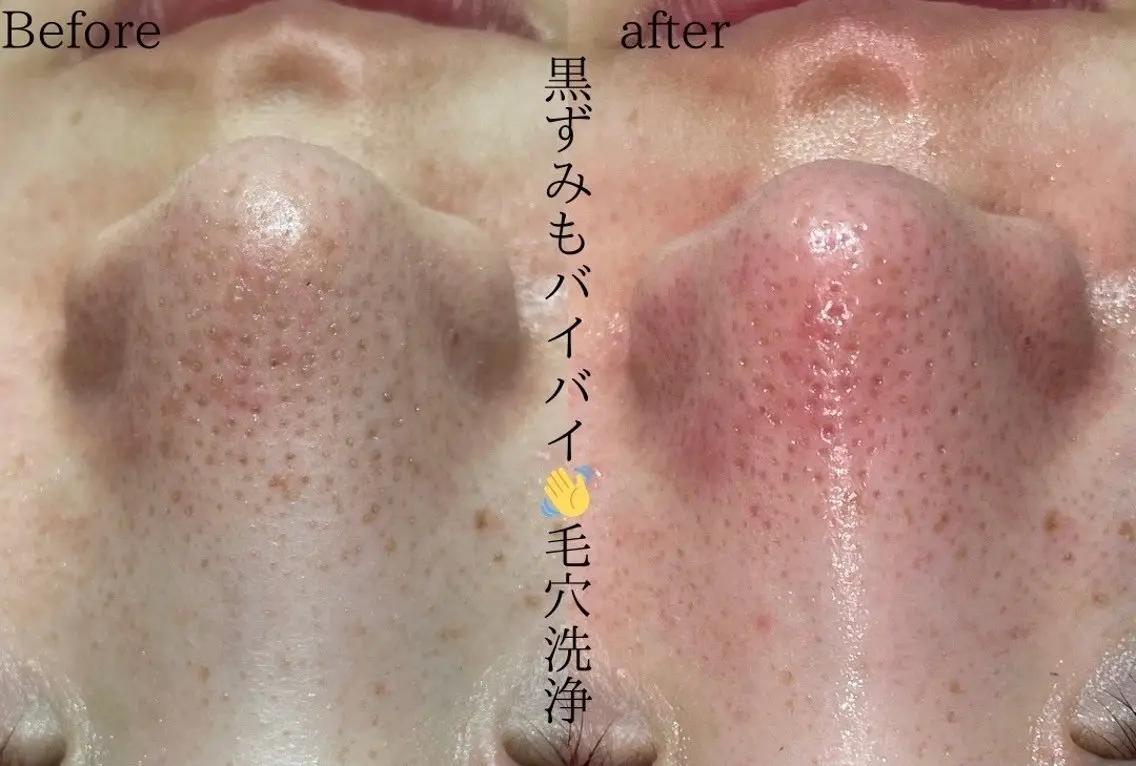 【初回限定】毛穴洗浄Tゾーンコース　メンズにもおすすめ！の写真