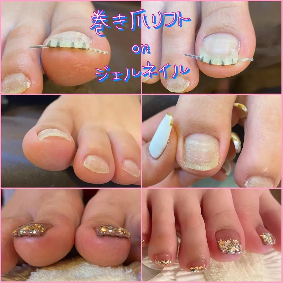 ネイル ジェルネイル ♢ME2ROOM♢ #巻き爪#リラクのネイルデザイン