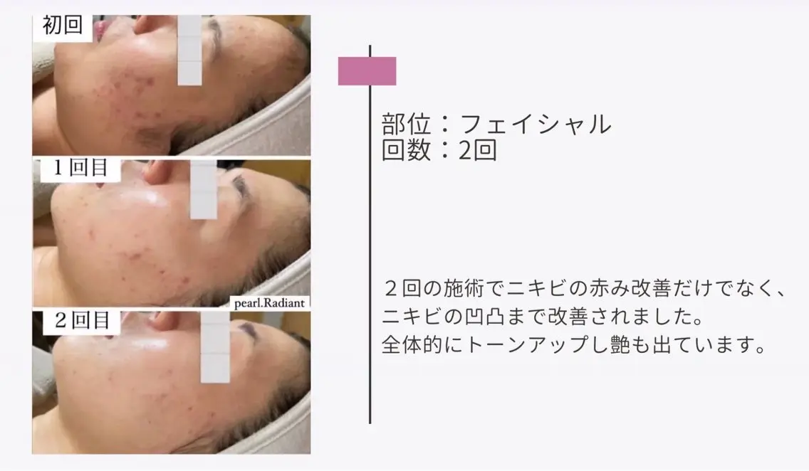 エステ 艶肌ワックス ALLY.のエステ・リラクイメージ