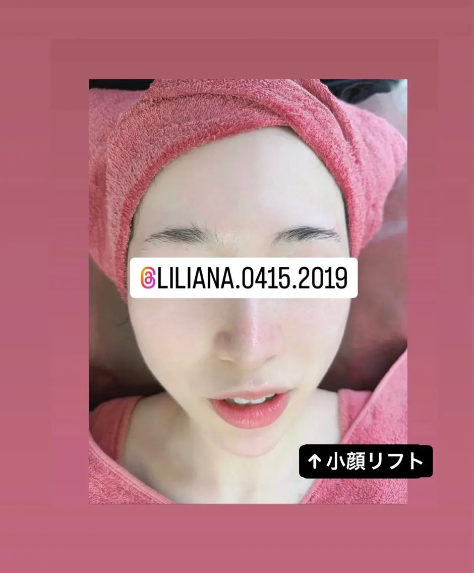 小顔＋水光肌仕上げ⭐️ミニモ限定⭐️陶肌トリートメント＋小顔筋膜マシーン‼️モデルさんなどもやられているハーブピーリングの写真