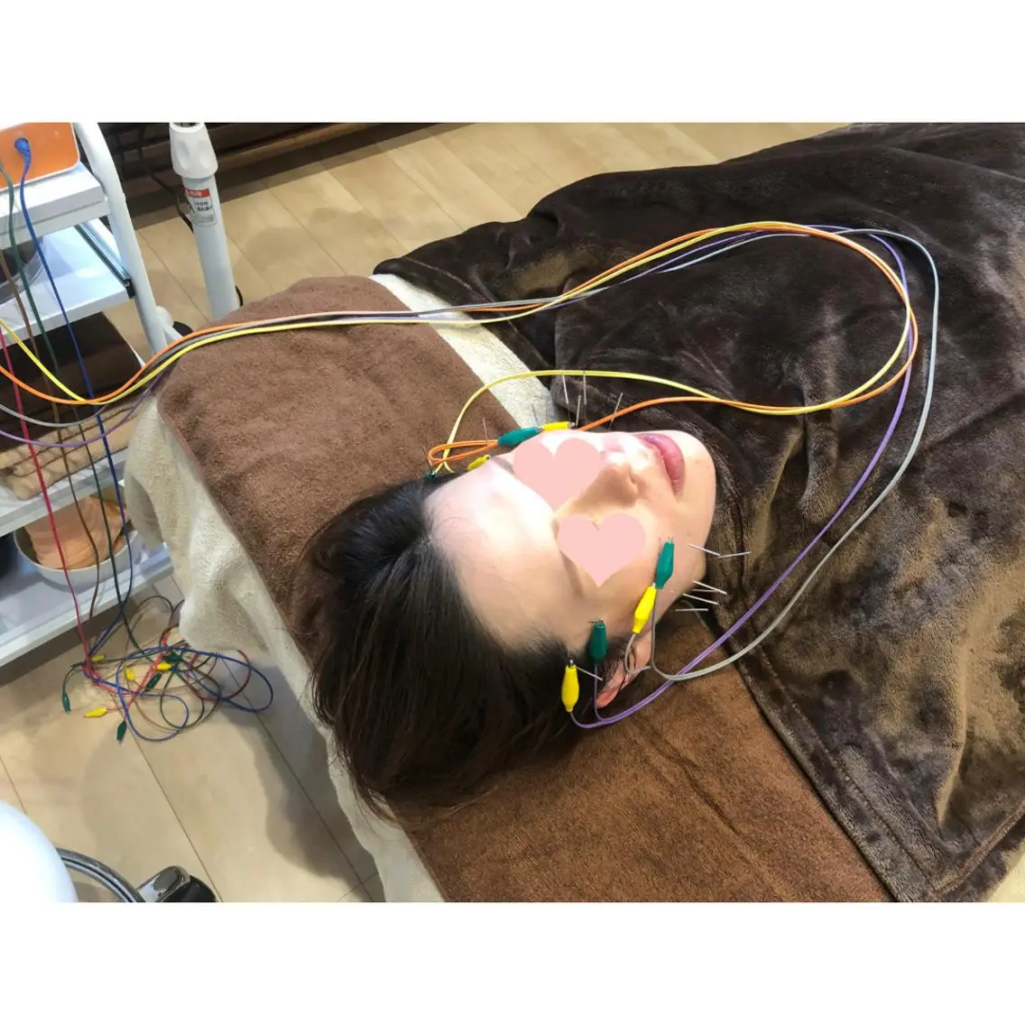 《ご新規様》《美容鍼スタンダードコース⭐️鍼20本》通電あり。たるみ、むくみ、シワに‼️まず試したい方⭐️の写真
