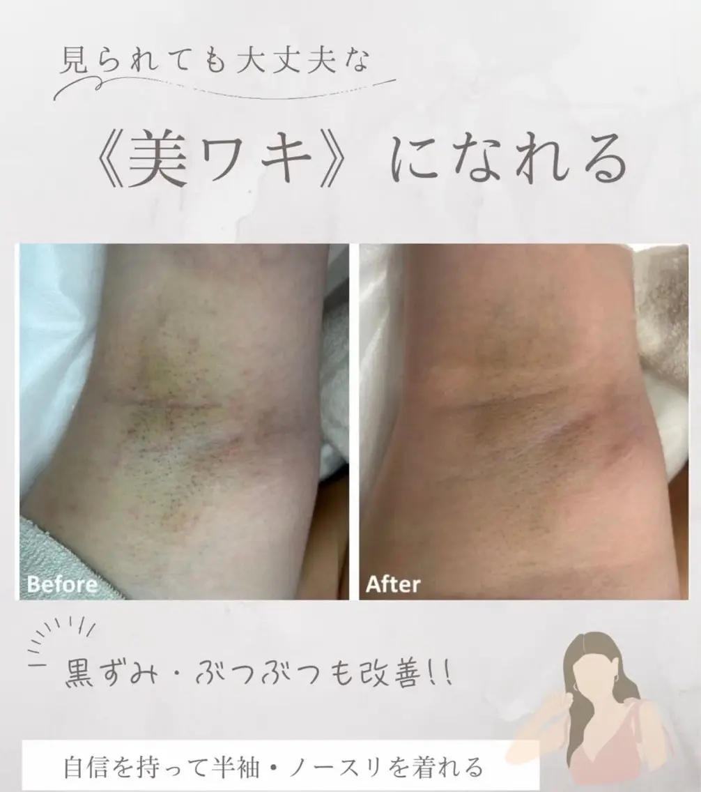 脇脱毛の写真