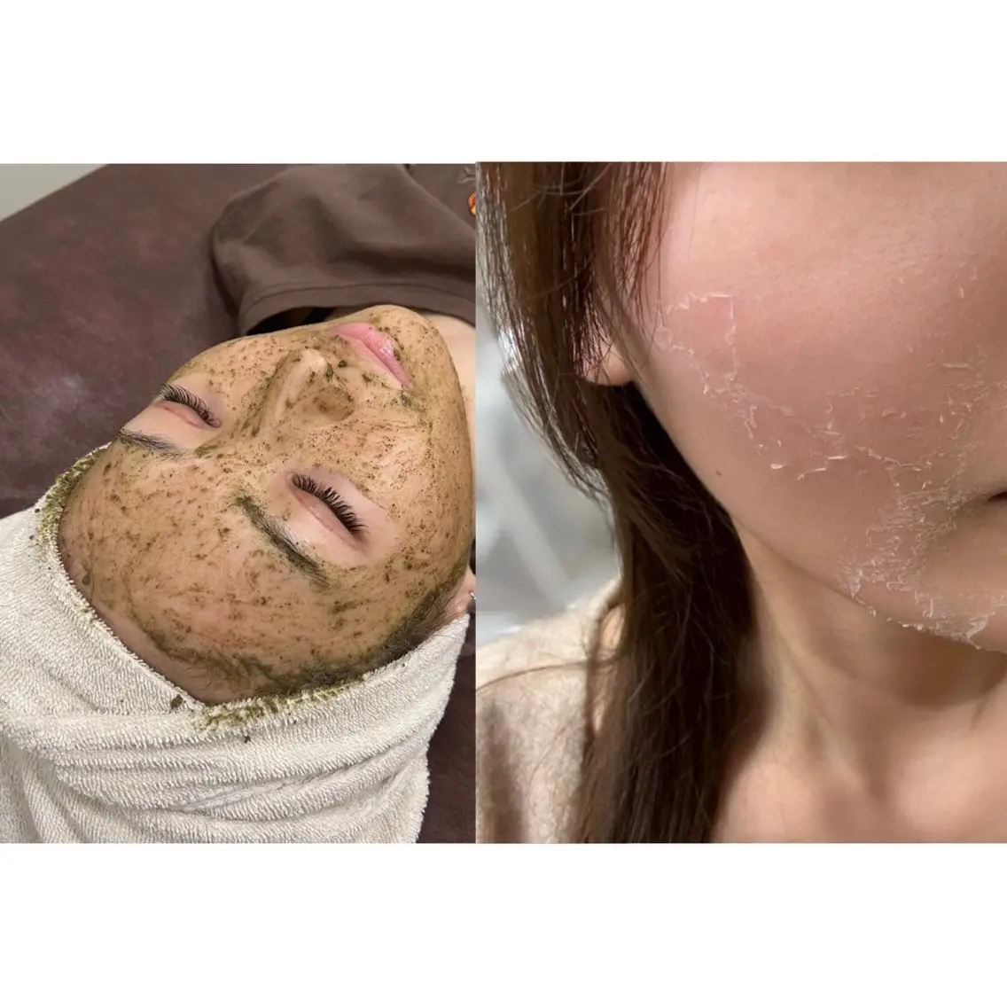 【劇的美肌改革×圧倒的変化】ローズドメーラ剥離ハーブピーリングの写真