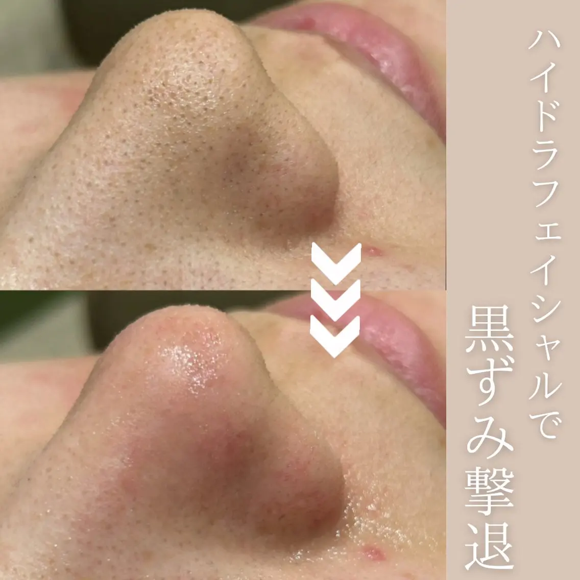 【無料体験】毛穴ごっそり体験🌟つるつるお肌実感🪞🎀の写真