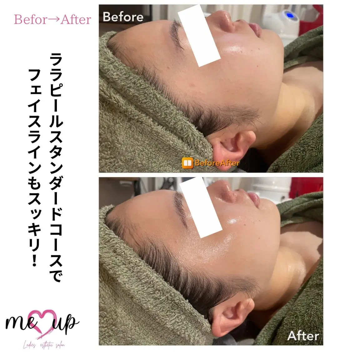 エステ Meupニキビ専門店 背中/ハーブ/肌管理のその他イメージ