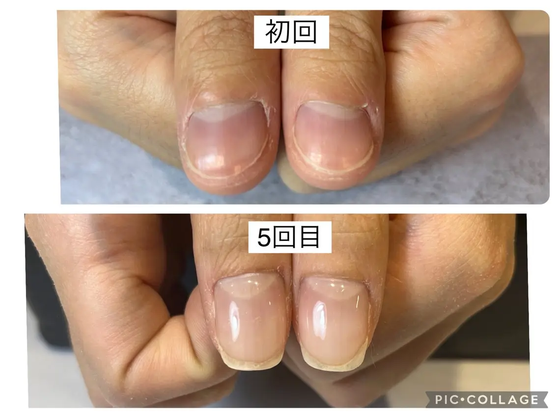 6/6限定！自爪育成ジェルコース（ホームケア付き）の写真
