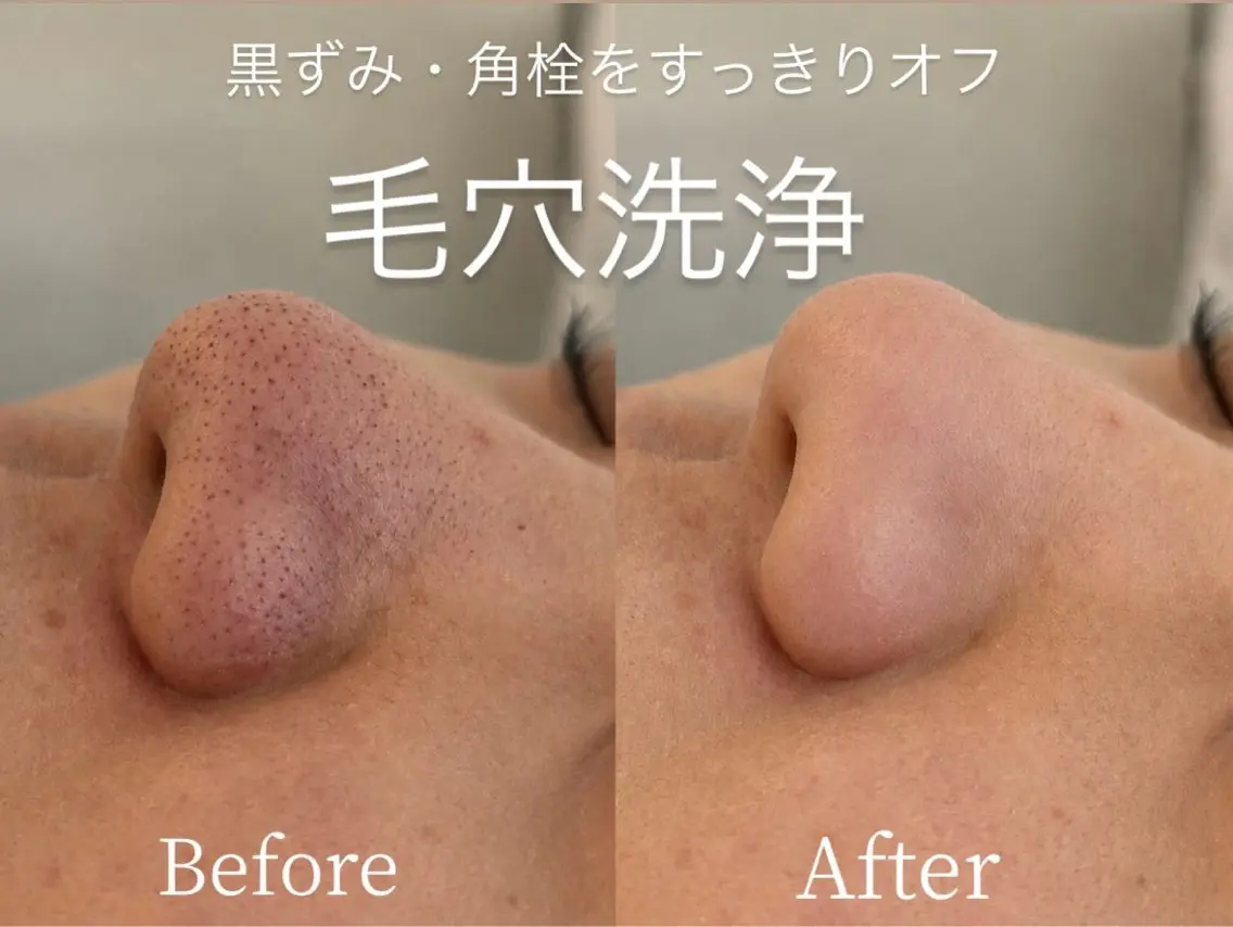 【人気No.1👑黒ずみ・角栓】毛穴洗浄＋角栓吸引＋ピーリング🫧の写真
