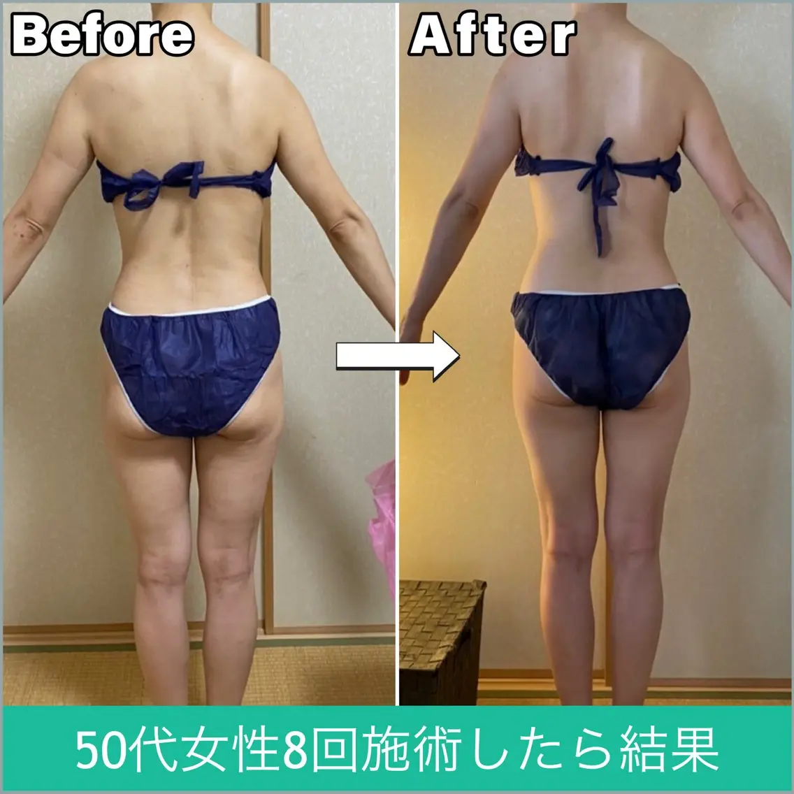 背中痩せダイエットの写真