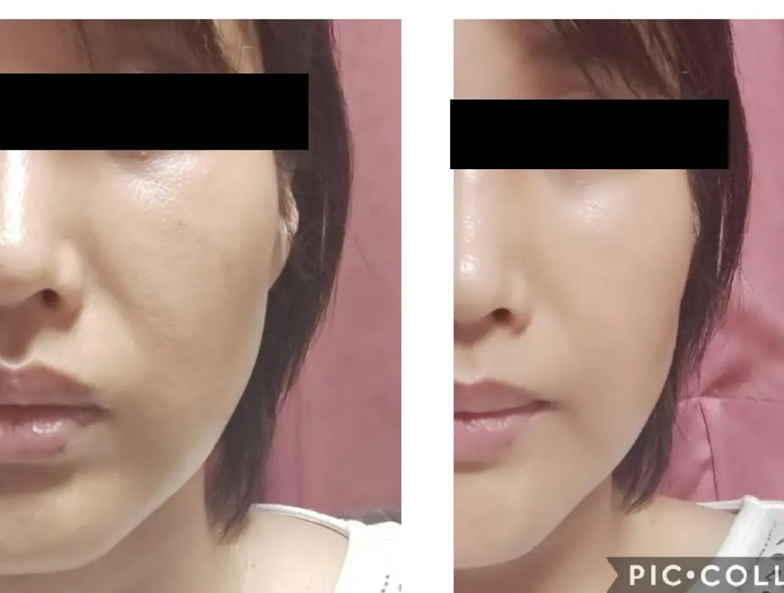 パイラナイトフェイシャル✨🍀リフトアップしたい方🍀艶、ハリがほしい方🍀ほうれい線改善したい方などの写真