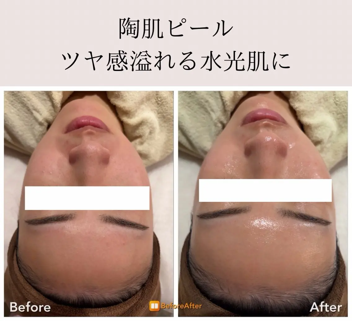 エステ Meup ニキビケア 毛穴・背中ニキビ専門のエステ・リラクイメージ