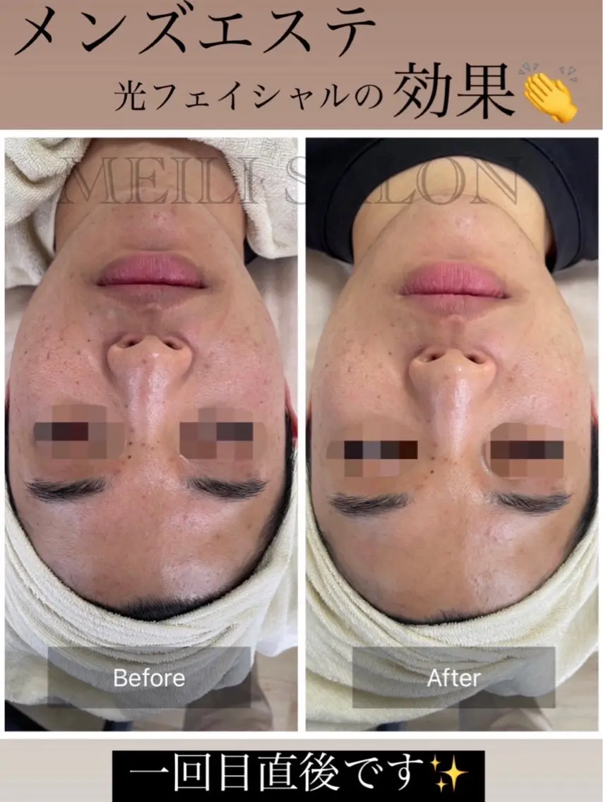 men's💁‍♂️メンズメニュー✨毛穴引き締め美肌🙌E光フェイシャルの写真