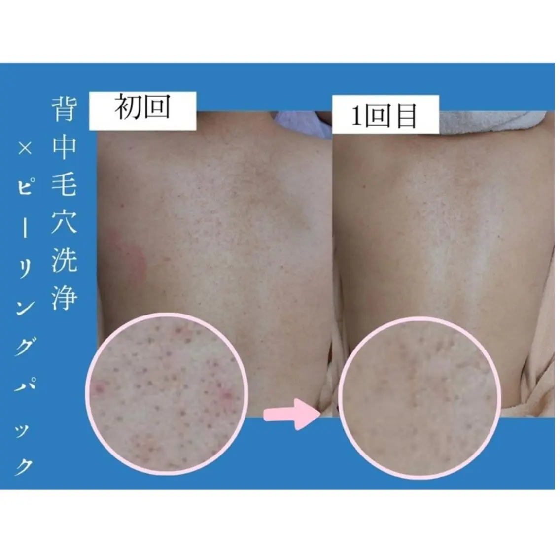 【背中ニキビ&シミ】背中ケアキャンペーン!肌みせ前にお肌ケア♪背中毛穴洗浄+肌別パック※クーポン内容要確認の写真