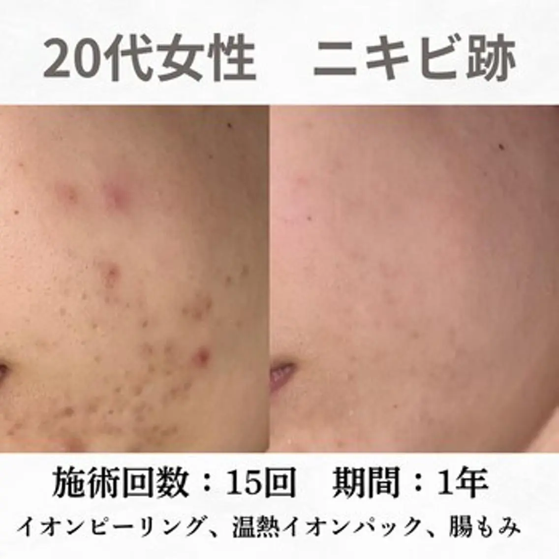 重度ニキビ専門🌼 ダウンタイムなしのエステ・リラクイメージ