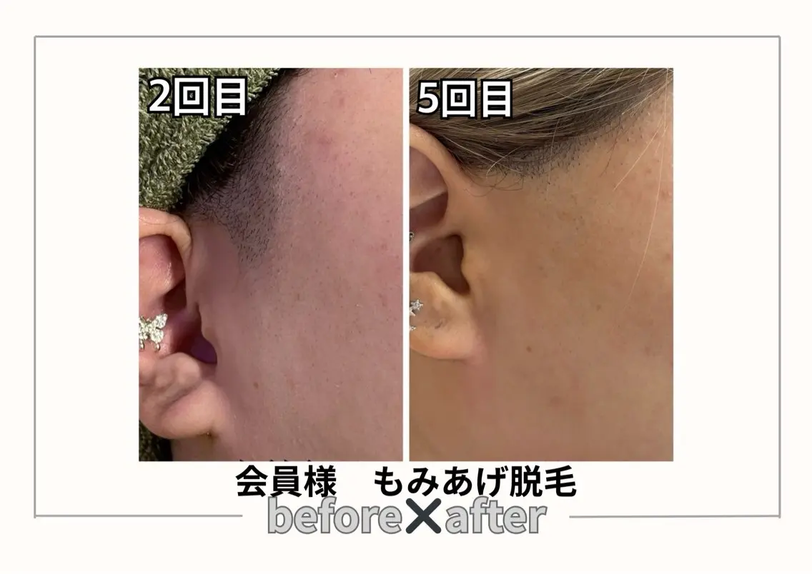 脱毛 みんなの脱毛ツルリン ☀️船橋店☀️のエステ・リラクイメージ