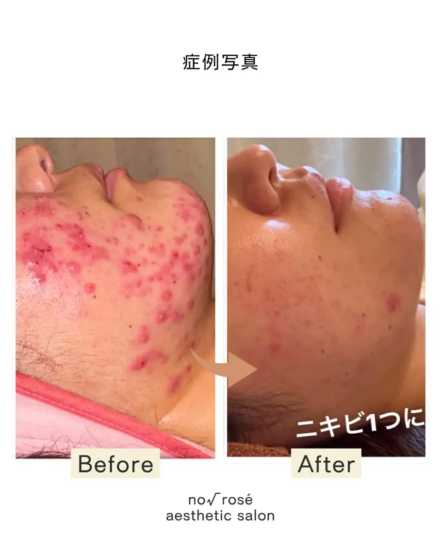 【もう辛いとは言わせない‼️】本気で悩んでいるなら当店人気No.1剥離ありハーブピーリング🌿治せないニキビは無いの写真
