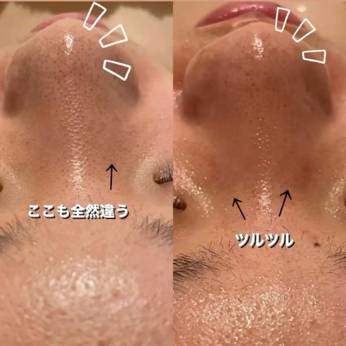 【つるんとスッキリ肌】乾燥・毛穴の黒ずみ・透明感ケアの写真
