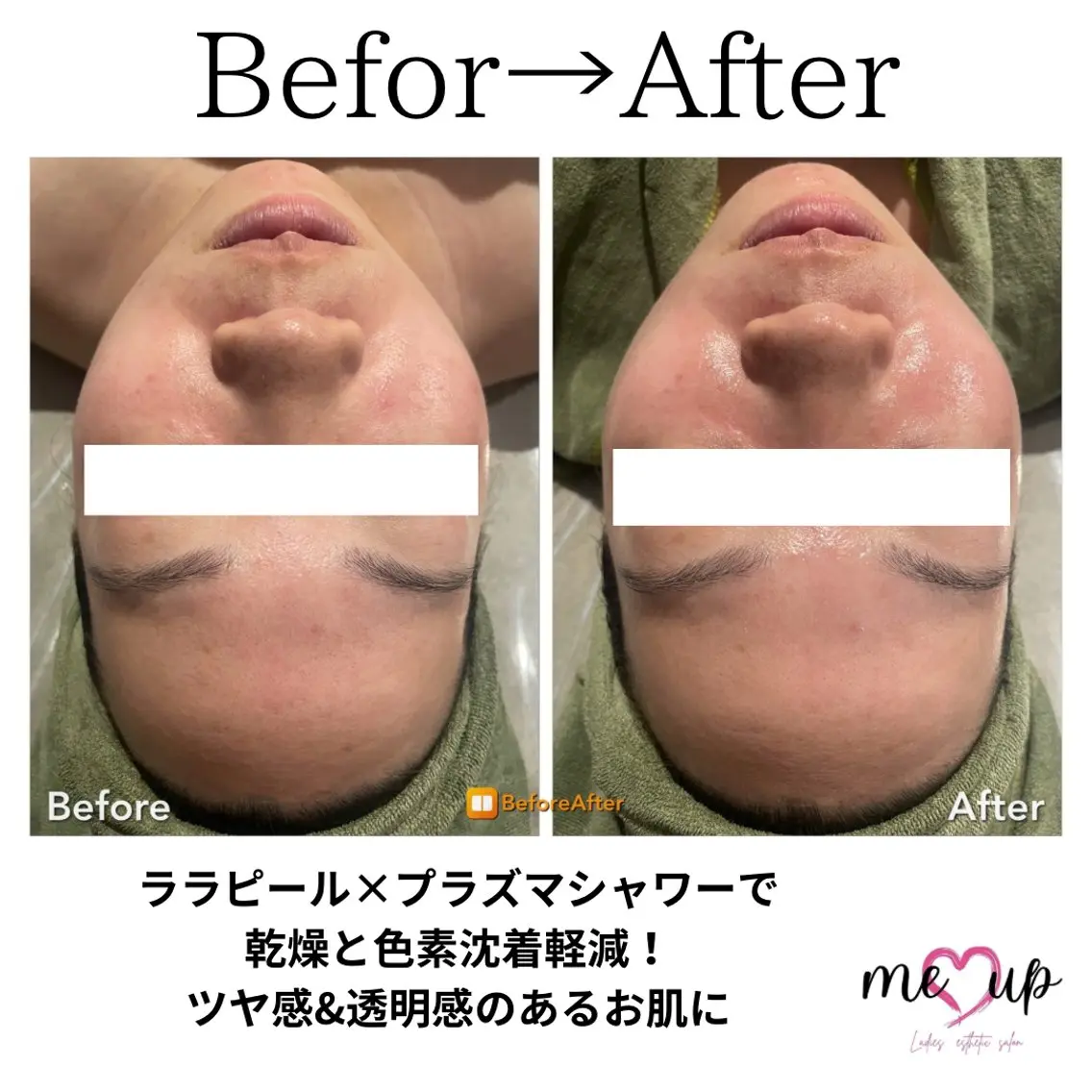 エステ Meupニキビ専門店 背中/ハーブ/肌管理のその他イメージ