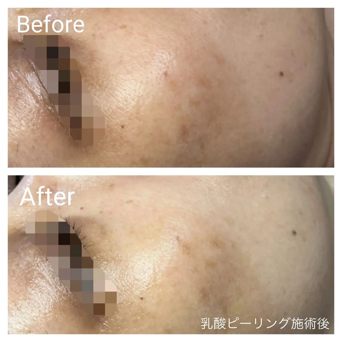 🌼季節の変わり目・お肌のくすみに🌼低刺激乳酸ピーリング＋ラジオ波付きフェイシャル90分の写真