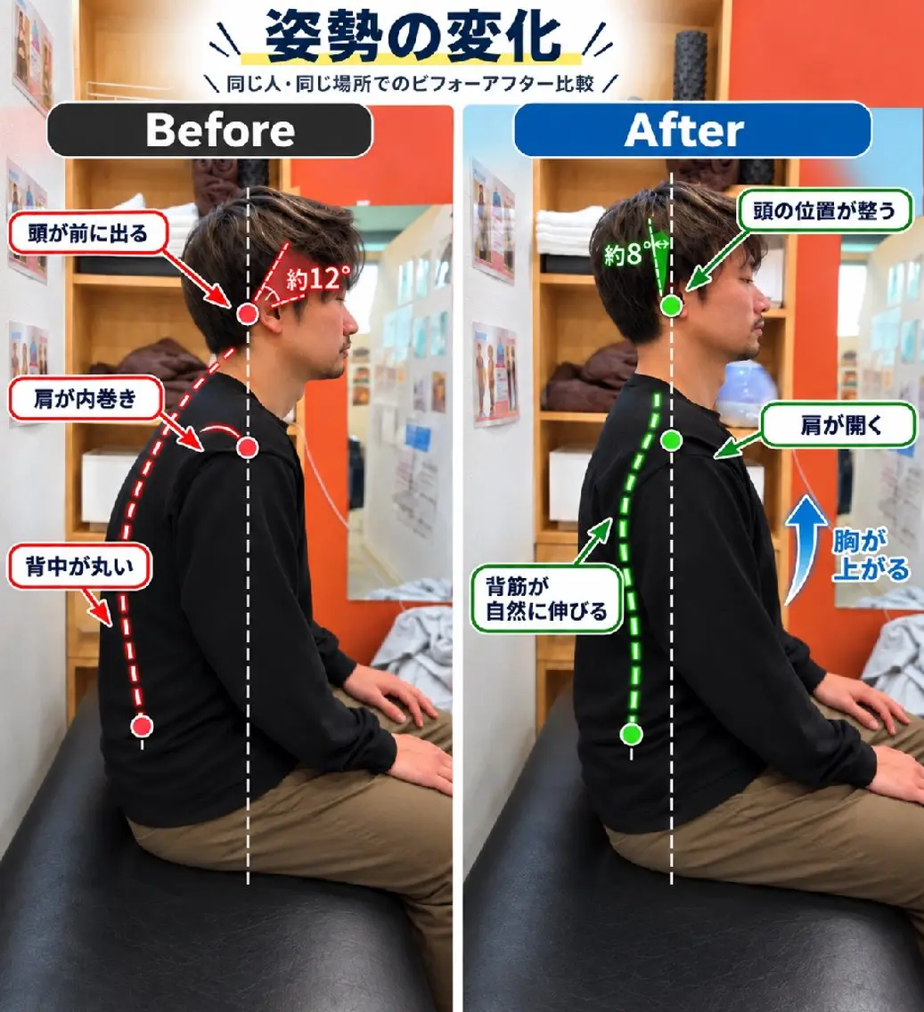 【猫背・巻き肩に】後ろ姿までキレイに✨姿勢・骨格矯正の写真