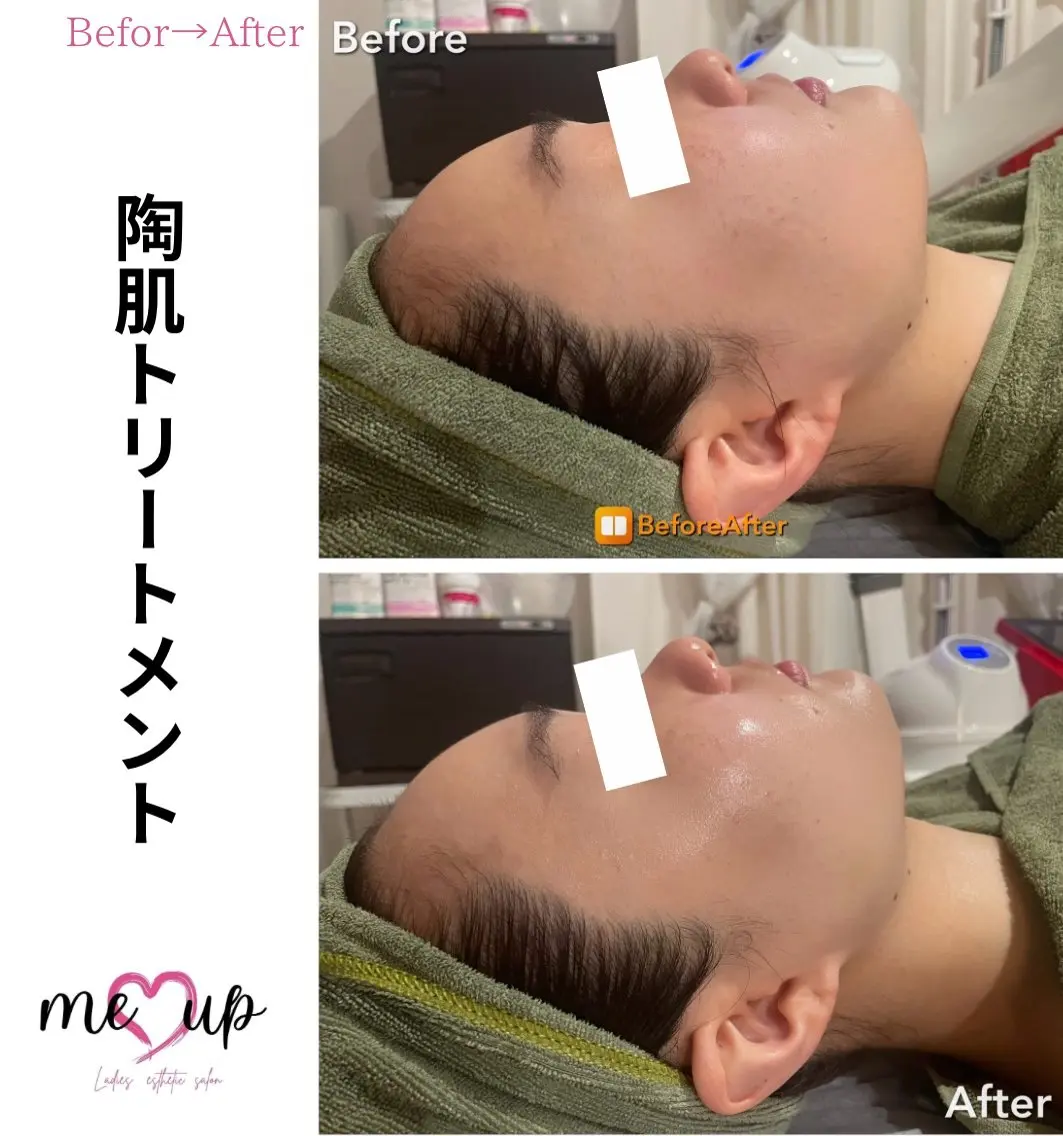 Meupニキビ専門店 背中/ハーブ/肌管理のその他イメージ
