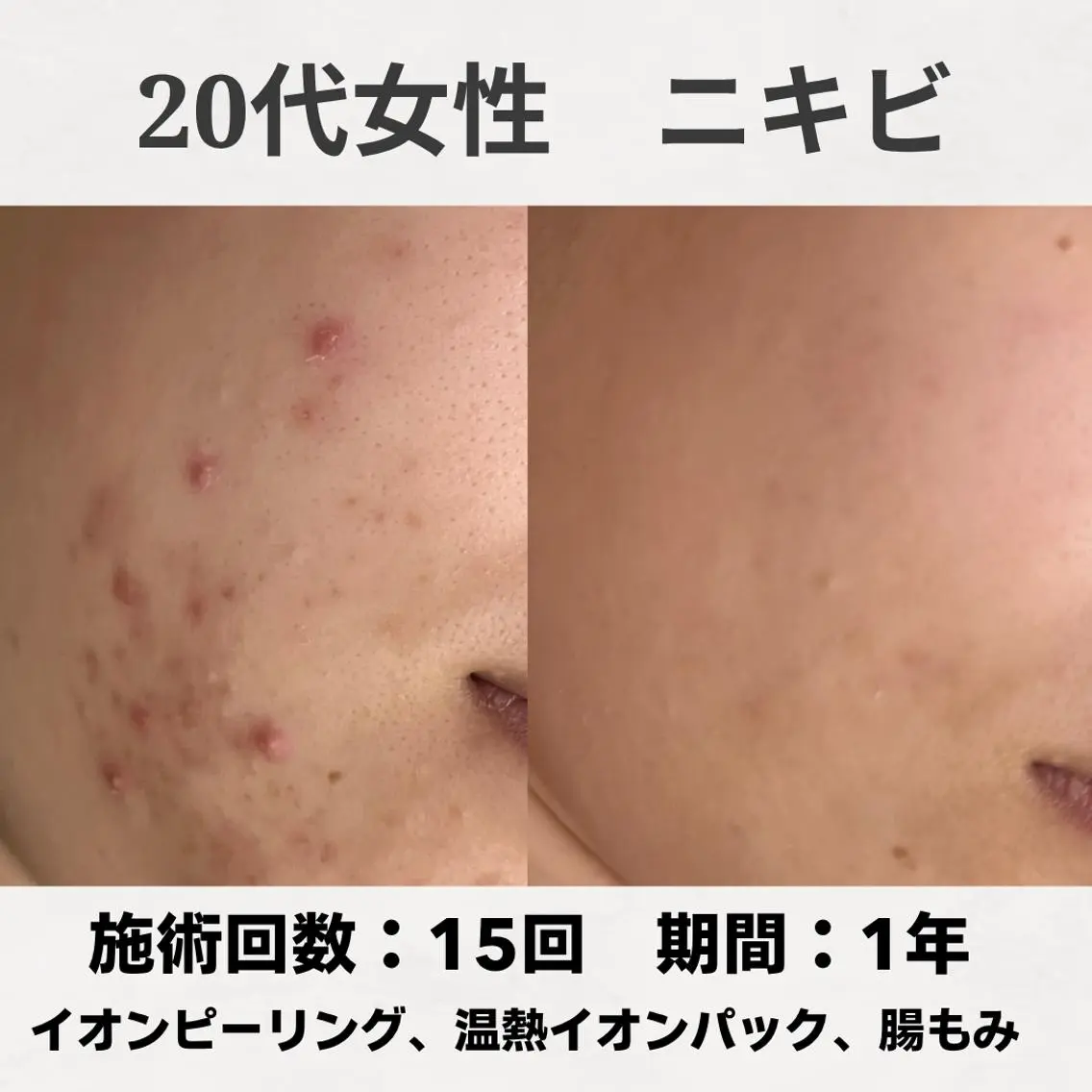 エステ リラク ニキビ跡改善専門🔥 医療にはできない改善のエステ・リラクイメージ