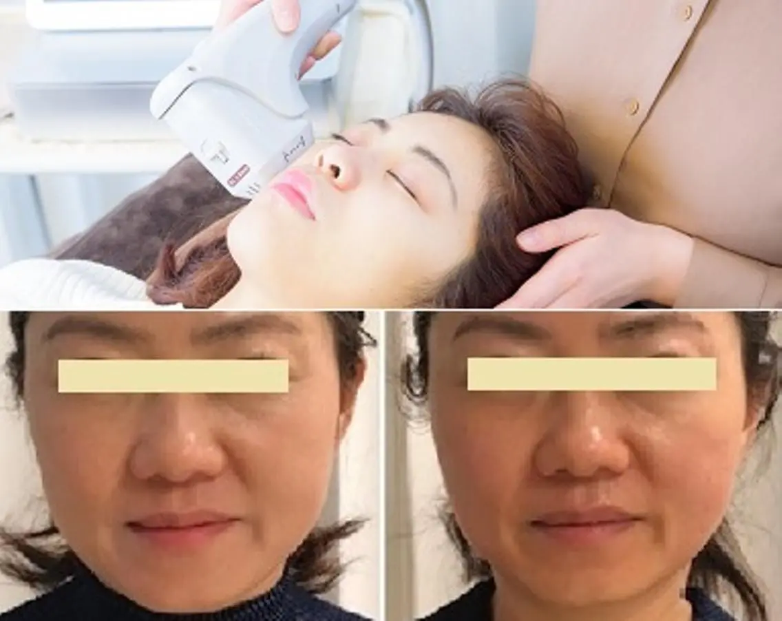 【小顔】人気No.2:スーパーリフト★美容機器唯一1回で分解!諦めない圧倒的小顔の写真