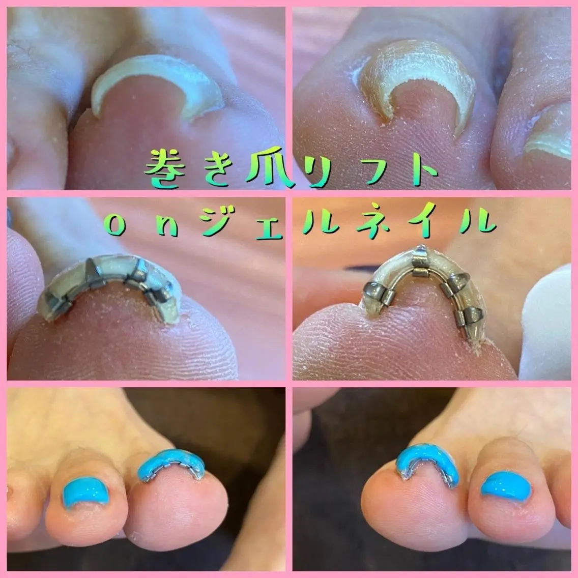 ネイル ジェルネイル ♢ME2ROOM♢ #巻き爪#リラクのネイルデザイン