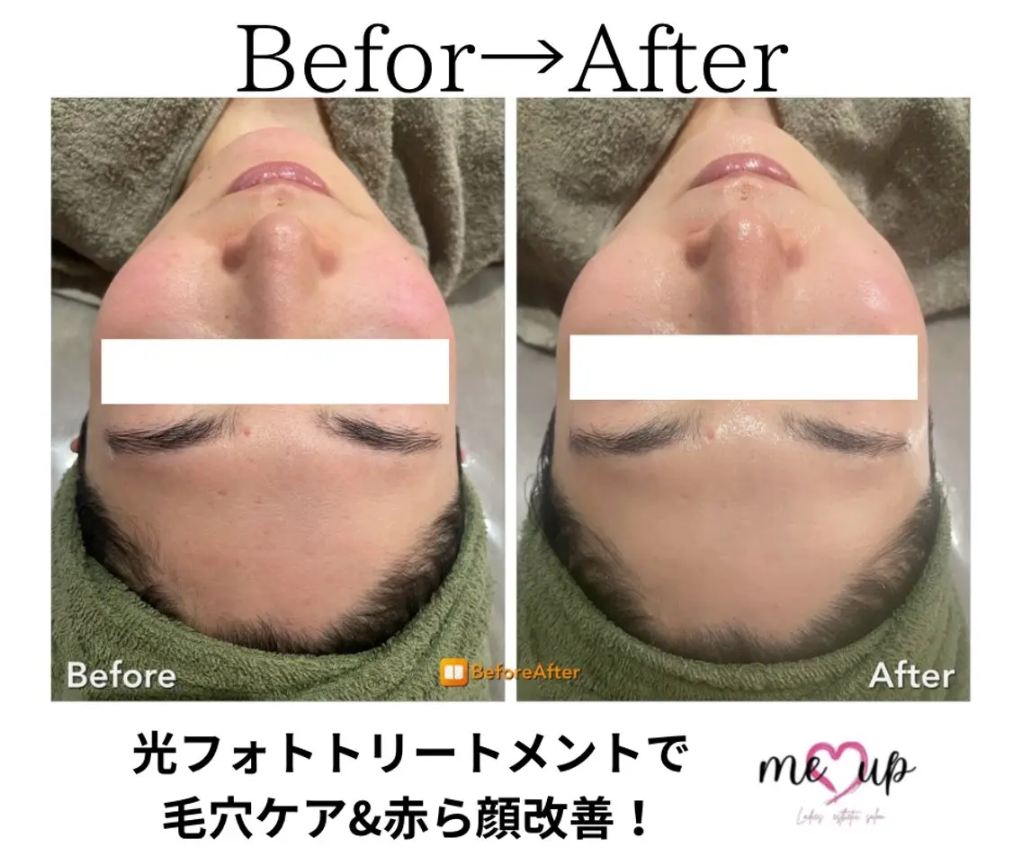 エステ Meupニキビ専門店 背中/ハーブ/肌管理のその他イメージ