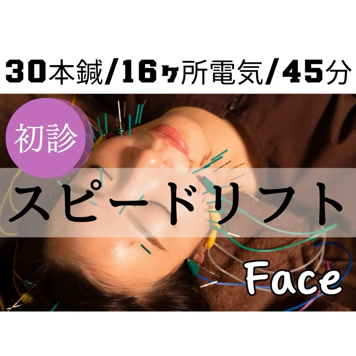 その他 即小顔♥️美容鍼× ハーブピーリングのその他イメージ