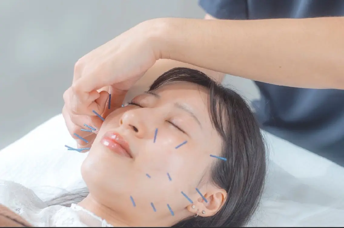 美容鍼の写真