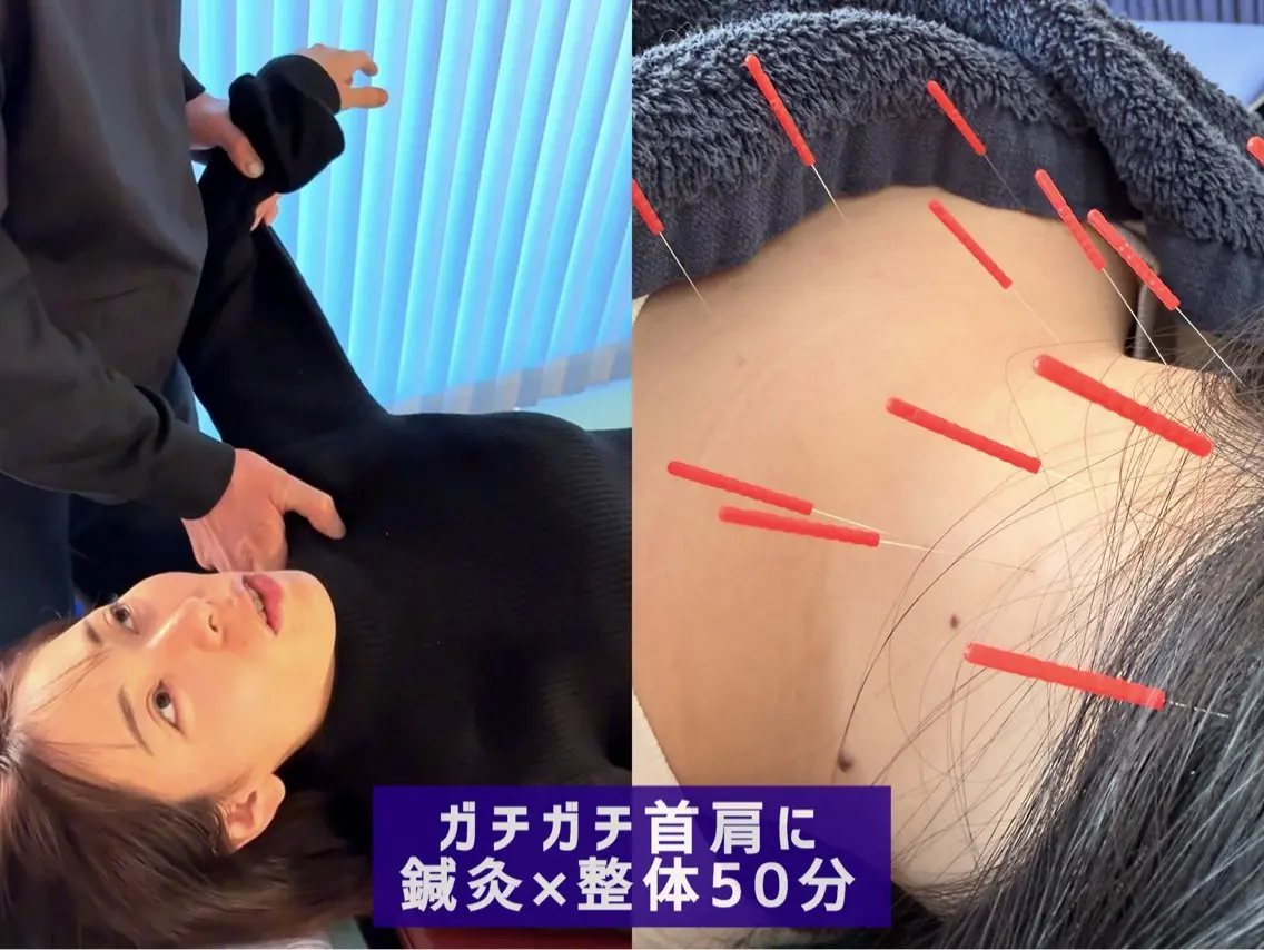 【ガチガチ首・肩こり】首肩集中の鍼×骨盤整体 50分の写真