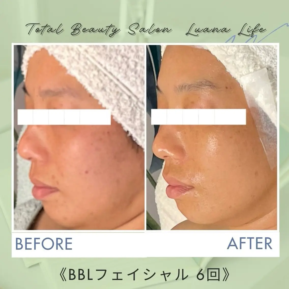 －5歳肌✨️肌質改善 LuanaLifeのエステ・リラクイメージ